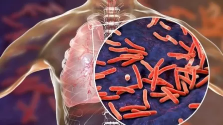 На 24% снизилась заболеваемость туберкулезом в Казахстане